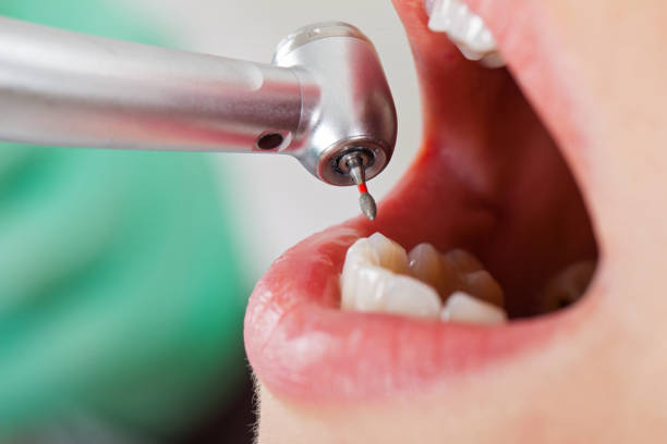 Best Emergency Wisdom Teeth Removal in Waterville, ME